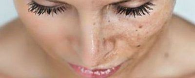 Dark Spot Treatment