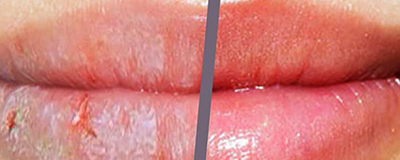 Lip Care