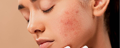 Dry Skin